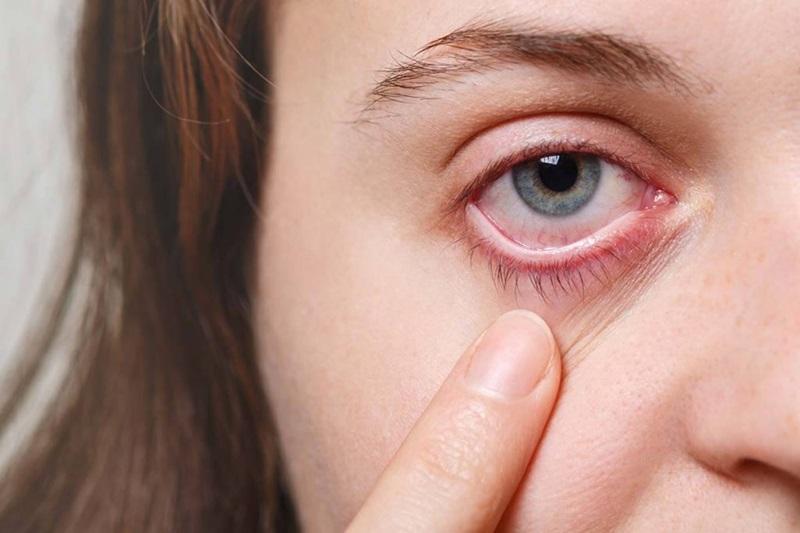 Üveit: Göz Hastalıklarının Gizemli Yönü, Nedir Nasıl Tedavi Edilir?
