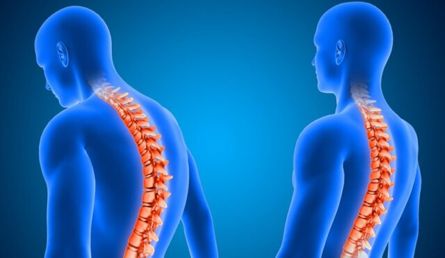 Ankilozan Spondilit (AS) Nedir? Belirtileri Nelerdir?