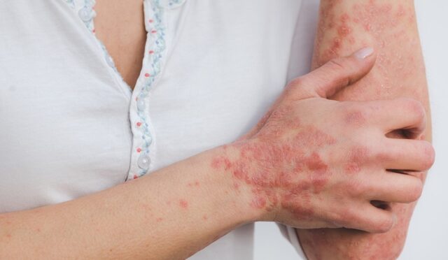 Kelebek Hastalığı (Lupus): Nedenleri, Belirtileri Nedir?